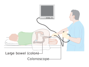 Diagram_showing_a_colonoscopy_CRUK_060.svg